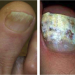 nail fungus