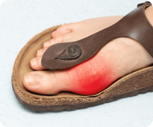 Hallux Limitus/Rigidus