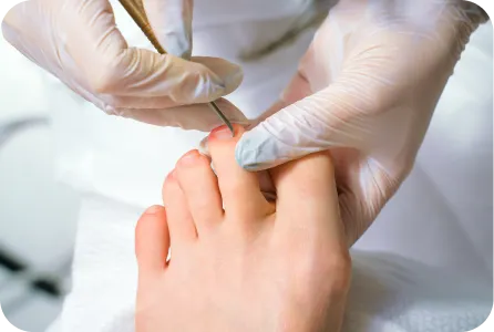 Ingrown Toenails