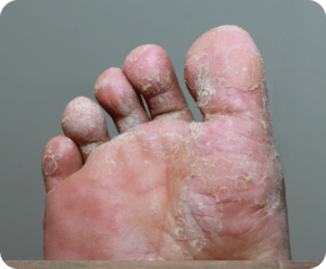 Athlete’s Foot (Tinea Pedis)