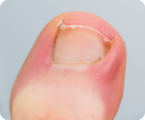 Ingrown Nails